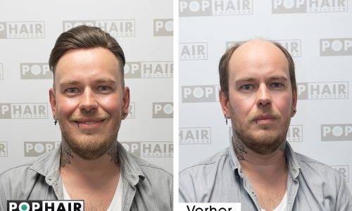 ContactSkin Haarersatz vorn - voher nachher